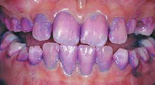 purple gums